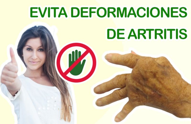 ¿Cómo evitar deformaciones por artritis? ¡5 Consejos Naturales!