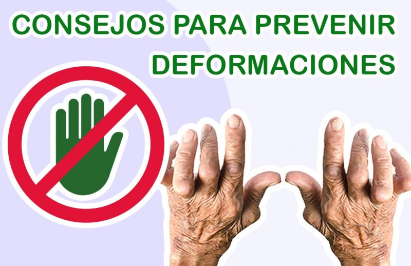3 Consejos para Prevenir las Deformaciones de Artritis