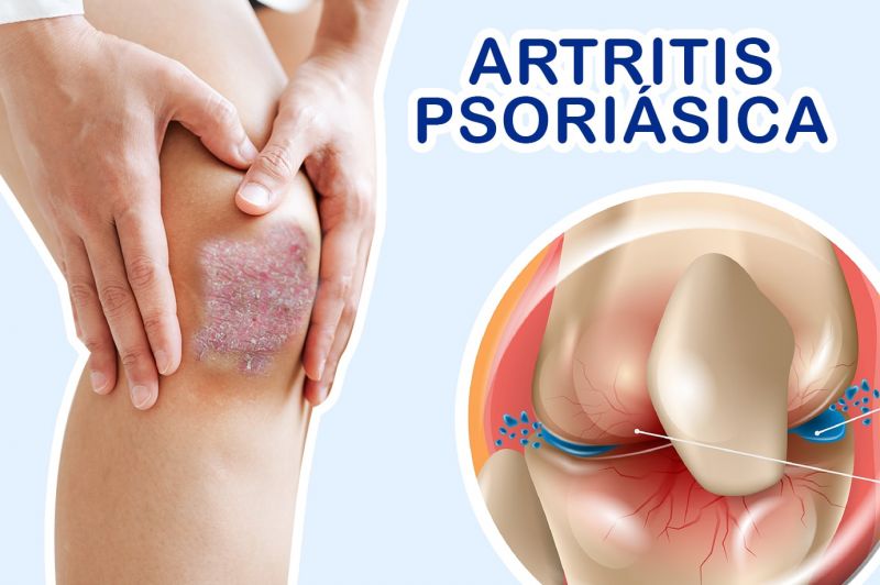 Artritis Psoriásica: Qué es, Causas, Síntomas y Tratamiento