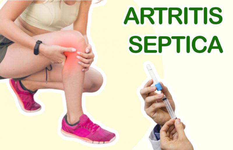Artritis Séptica