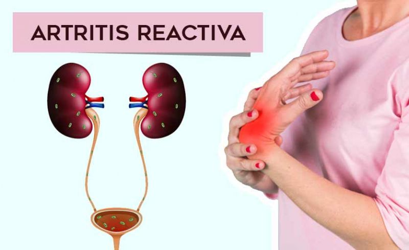 Artritis Reactiva: Qué es, Causas, Síntomas, Tratamiento Natural