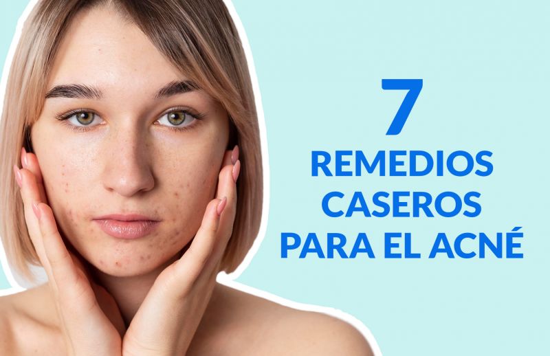 7 Remedios Caseros para el Acné