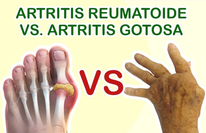 Artritis reumatoide versus artritis gotosa