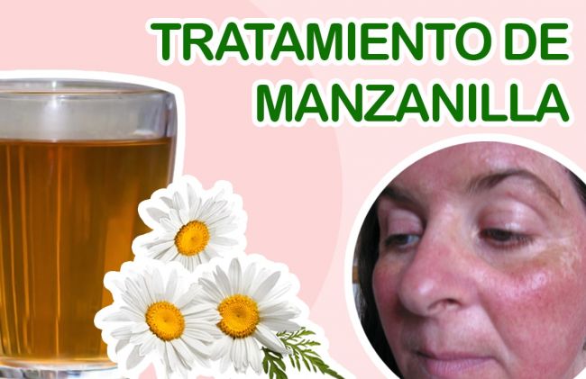 Qué Es La Rosácea Tratamiento De Manzanilla Nuevas Evas