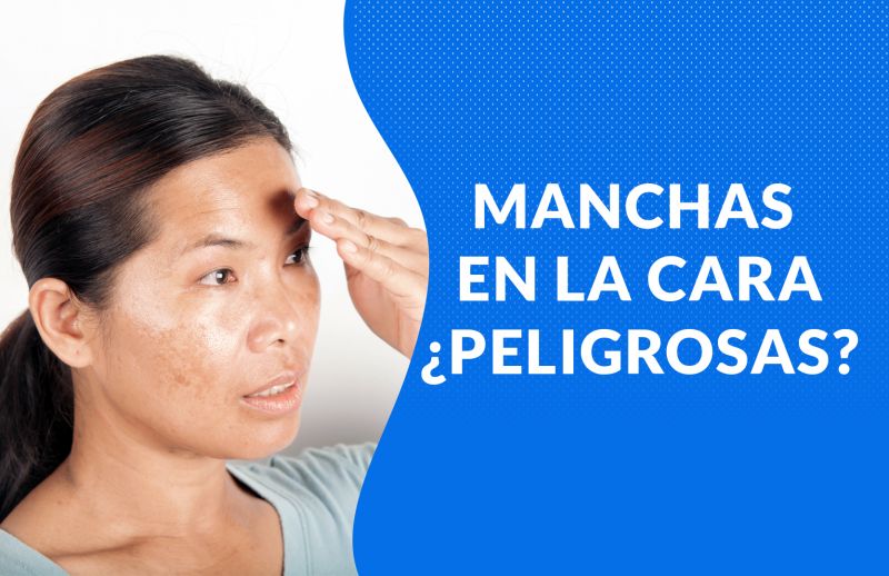 Manchas en la cara: ¿Cómo saber si son peligrosas?