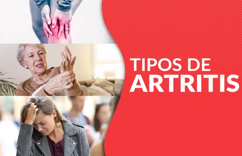 ¿Qué tipos de artritis afectan con más frecuencia a las mujeres?