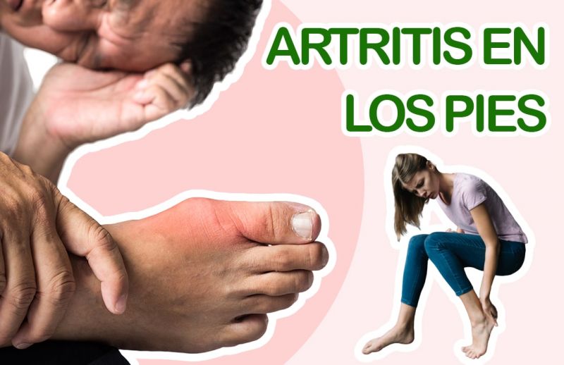 Artritis En Los Pies Como Curarla Y Cuales Son Los Sintomas Artritis Tratamiento Natural Y